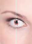 Geïnfecteerde Contactlens Met Sterkte