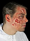 Heridas De Quemaduras Por Radiación De Látex
