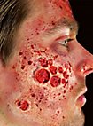 Heridas De Quemaduras Por Radiación De Látex