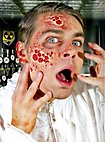 Heridas De Quemaduras Por Radiación De Látex