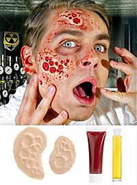 Strahlenbrand Wunden aus Latex