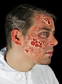 Strahlenbrand Latexapplikation